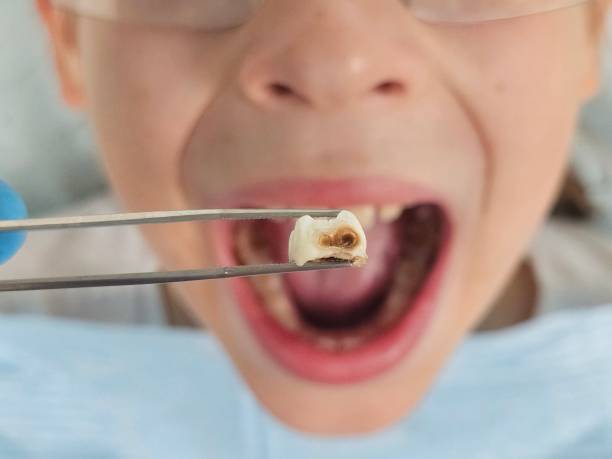 Best Knocked-Out Tooth (Avulsed Tooth) Treatment in Bonneauville, PA